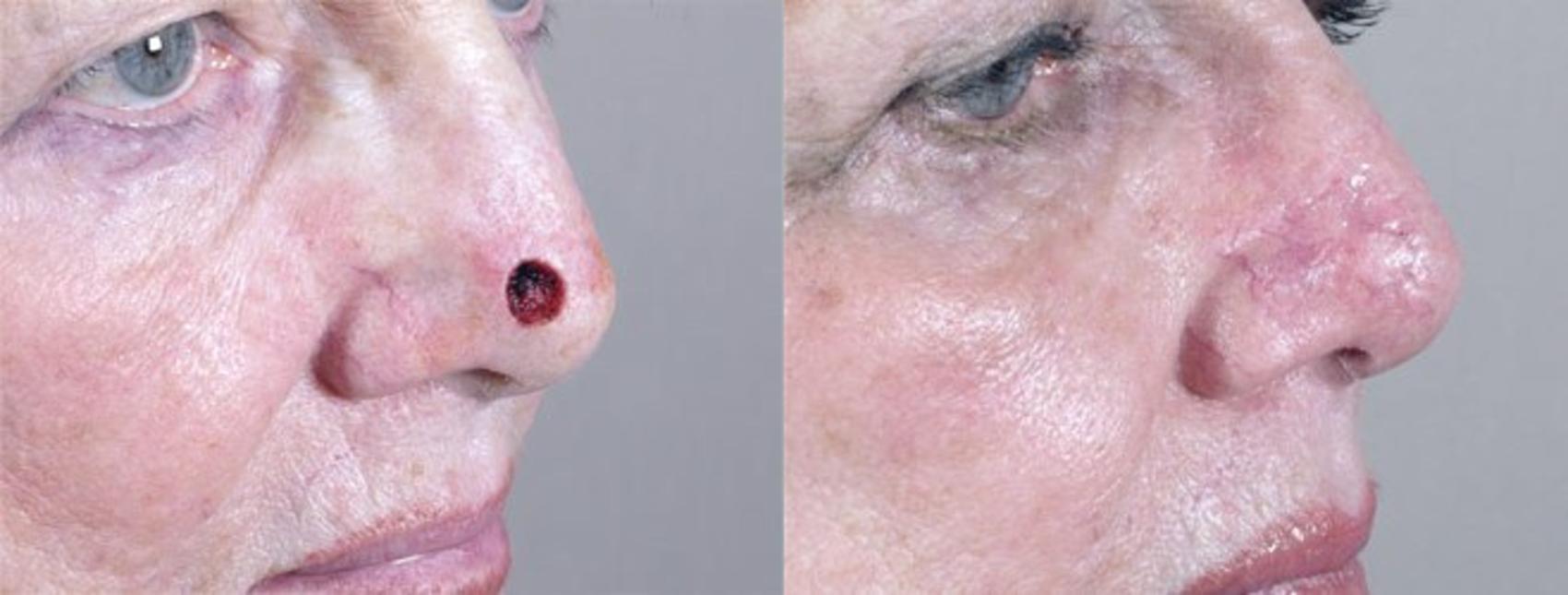 Skin Cancer Treatment Case 1059 Before & After View #1 | Paramus, New Jersey | Parker Center for Plastic Surgery