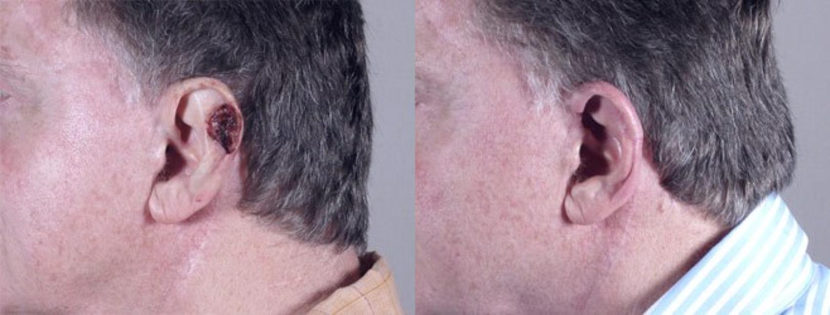 Skin Cancer Treatment Case 1060 Before & After View #1 | Paramus, New Jersey | Parker Center for Plastic Surgery