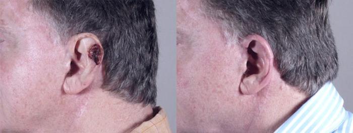 Skin Cancer Treatment Case 1060 Before & After View #1 | Paramus, New Jersey | Parker Center for Plastic Surgery