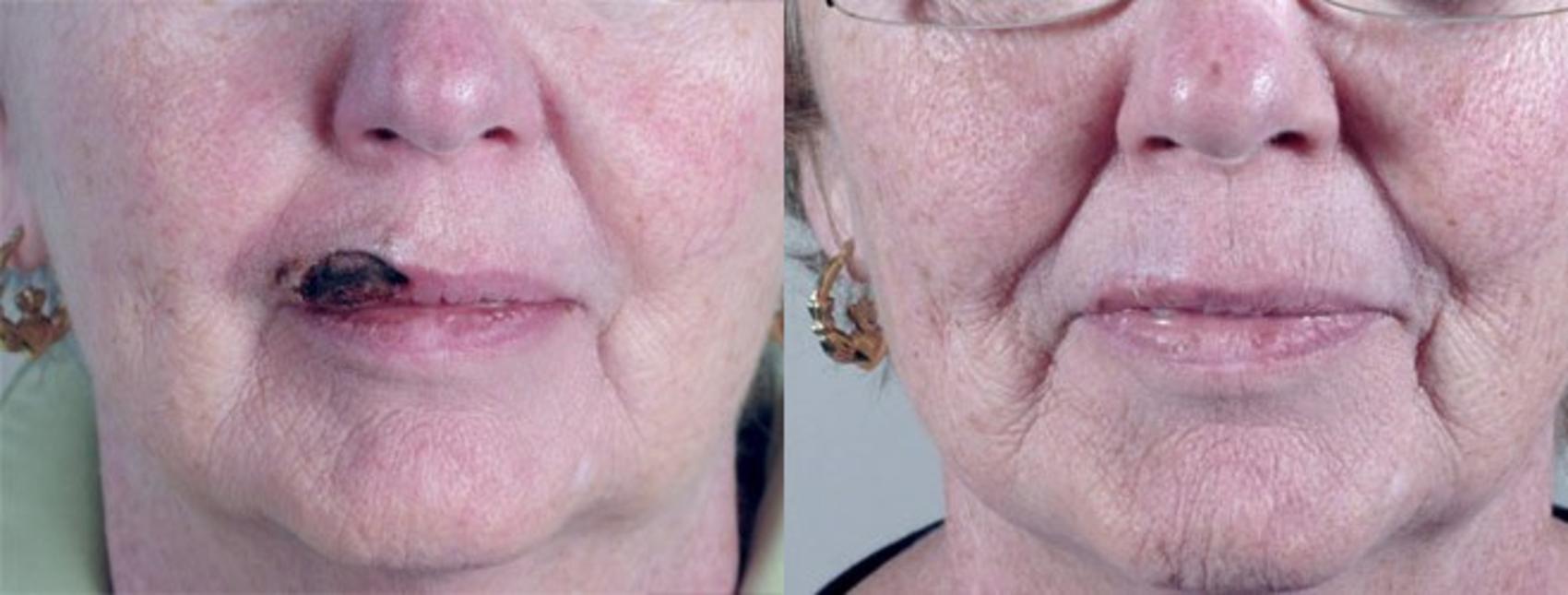 Skin Cancer Treatment Case 1061 Before & After View #1 | Paramus, New Jersey | Parker Center for Plastic Surgery
