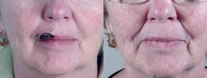 Skin Cancer Treatment Case 1061 Before & After View #1 | Paramus, New Jersey | Parker Center for Plastic Surgery