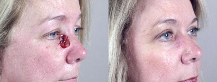 Skin Cancer Treatment Case 1062 Before & After View #1 | Paramus, New Jersey | Parker Center for Plastic Surgery