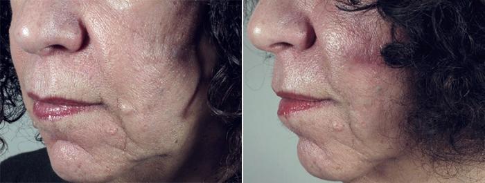 Skin Cancer Treatment Case 1063 Before & After View #1 | Paramus, New Jersey | Parker Center for Plastic Surgery