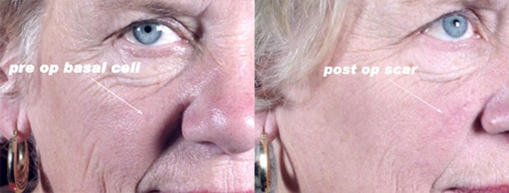 Skin Cancer Treatment Case 1064 Before & After View #1 | Paramus, New Jersey | Parker Center for Plastic Surgery