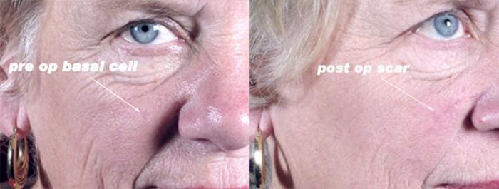 Skin Cancer Treatment Case 1064 Before & After View #1 | Paramus, New Jersey | Parker Center for Plastic Surgery
