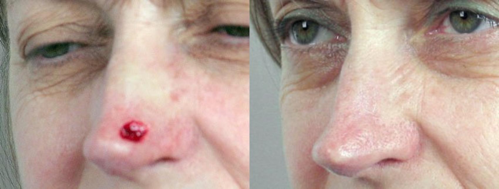 Skin Cancer Treatment Case 1065 Before & After View #1 | Paramus, New Jersey | Parker Center for Plastic Surgery