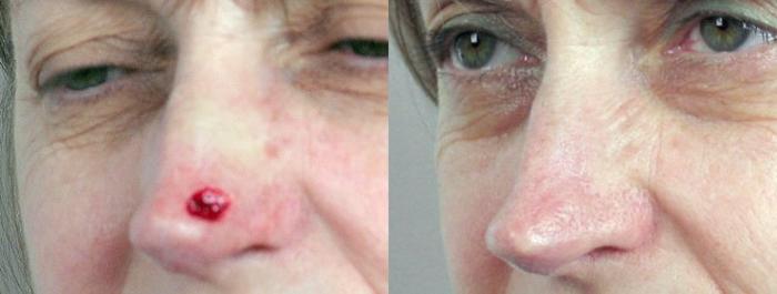 Skin Cancer Treatment Case 1065 Before & After View #1 | Paramus, New Jersey | Parker Center for Plastic Surgery