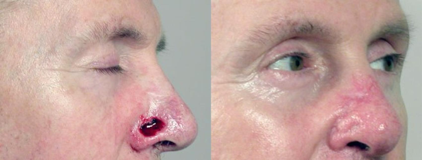 Skin Cancer Treatment Case 1066 Before & After View #1 | Paramus, New Jersey | Parker Center for Plastic Surgery