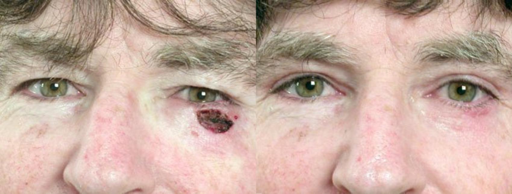 Skin Cancer Treatment Case 1067 Before & After View #1 | Paramus, New Jersey | Parker Center for Plastic Surgery