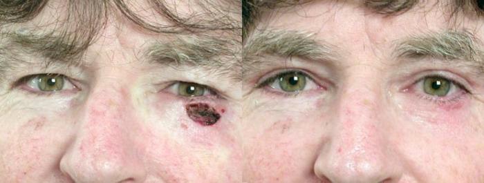 Skin Cancer Treatment Case 1067 Before & After View #1 | Paramus, New Jersey | Parker Center for Plastic Surgery