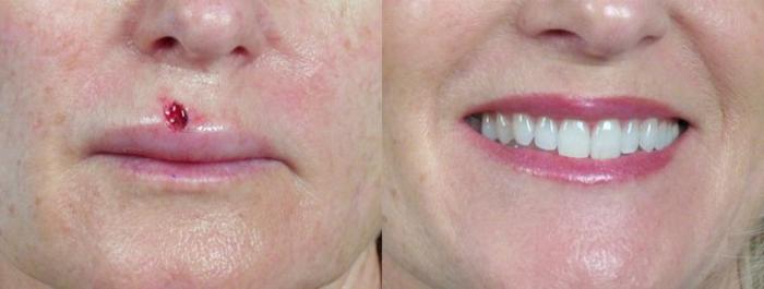 Skin Cancer Treatment Case 1068 Before & After View #1 | Paramus, New Jersey | Parker Center for Plastic Surgery