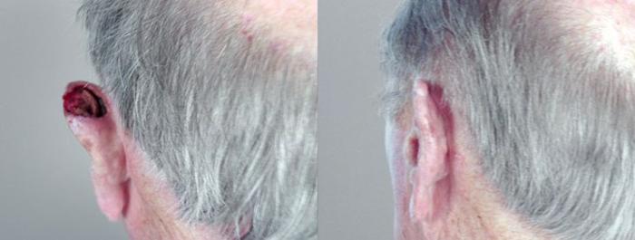 Skin Cancer Treatment Case 1069 Before & After View #1 | Paramus, New Jersey | Parker Center for Plastic Surgery