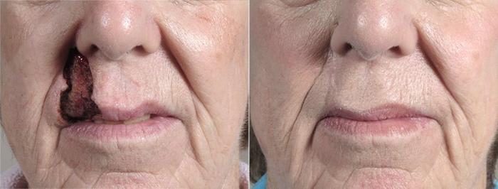 Skin Cancer Treatment Case 1070 Before & After View #1 | Paramus, New Jersey | Parker Center for Plastic Surgery