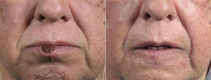 Skin Cancer Treatment Case 1071 Before & After View #1 | Paramus, New Jersey | Parker Center for Plastic Surgery