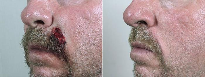 Skin Cancer Treatment Case 1072 Before & After View #1 | Paramus, New Jersey | Parker Center for Plastic Surgery