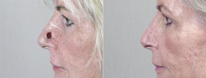 Skin Cancer Treatment Case 1073 Before & After View #1 | Paramus, New Jersey | Parker Center for Plastic Surgery