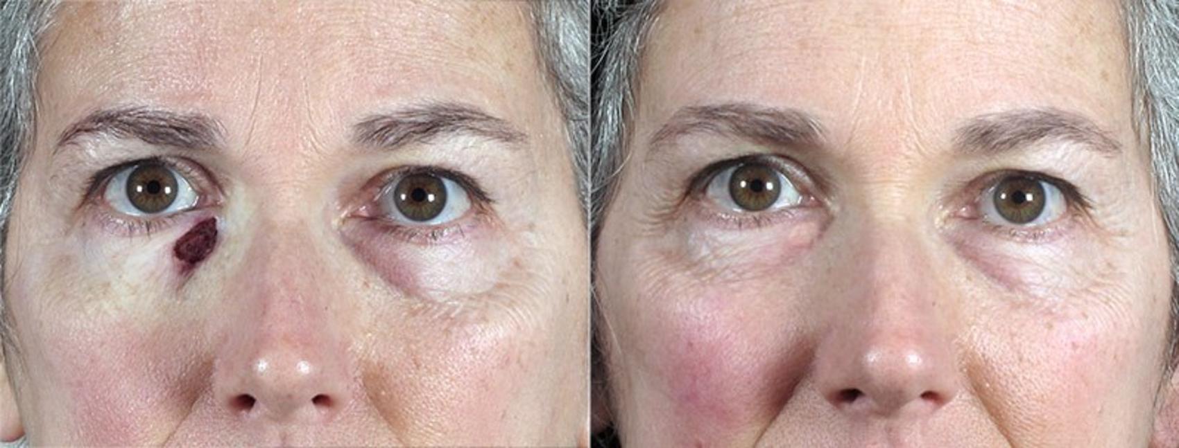 Skin Cancer Treatment Case 1074 Before & After View #1 | Paramus, New Jersey | Parker Center for Plastic Surgery