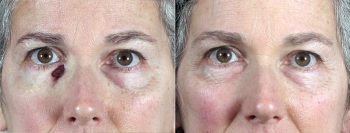 Skin Cancer Treatment Case 1074 Before & After View #1 | Paramus, New Jersey | Parker Center for Plastic Surgery