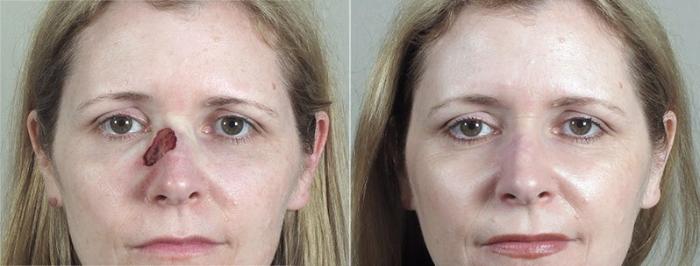 Skin Cancer Treatment Case 1075 Before & After View #1 | Paramus, New Jersey | Parker Center for Plastic Surgery