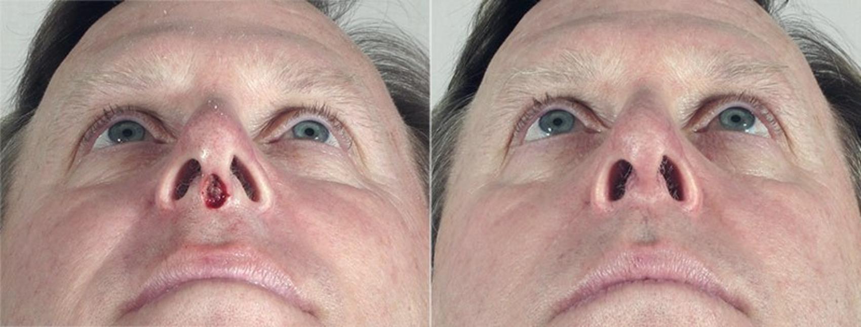 Skin Cancer Treatment Case 1078 Before & After View #1 | Paramus, New Jersey | Parker Center for Plastic Surgery