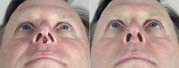 Skin Cancer Treatment Case 1078 Before & After View #1 | Paramus, New Jersey | Parker Center for Plastic Surgery