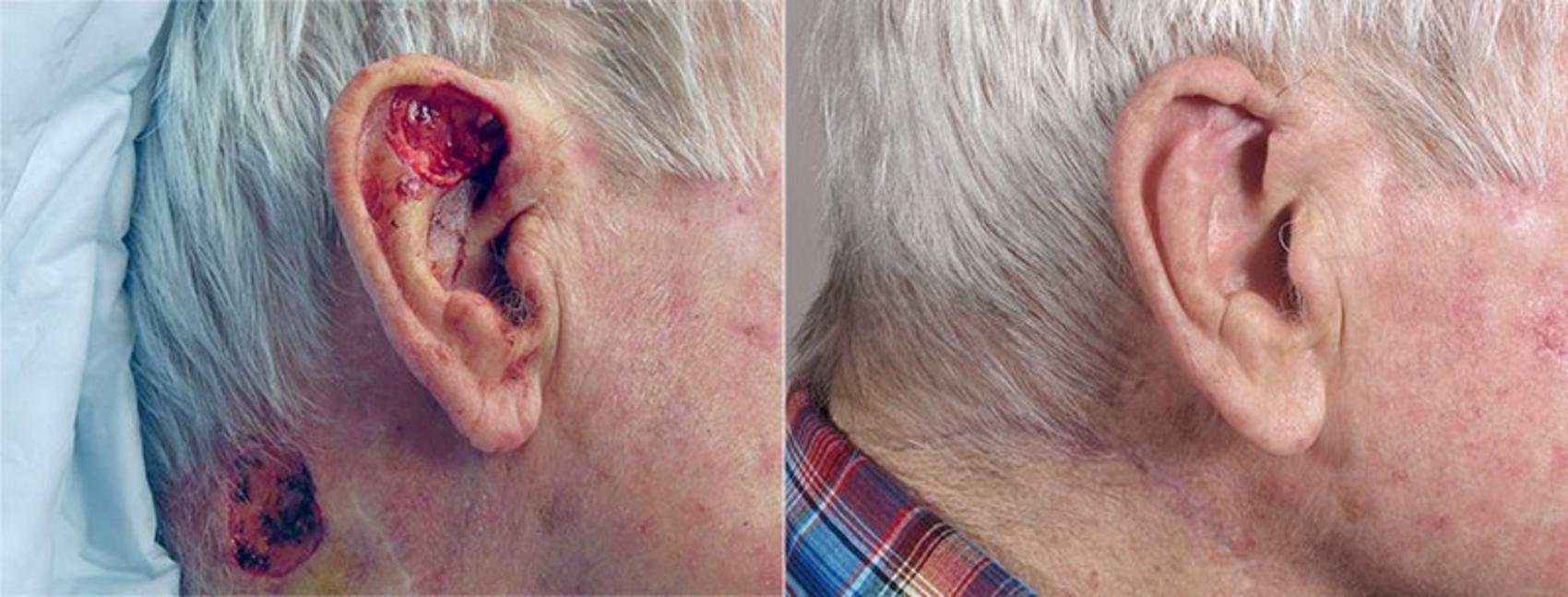 Skin Cancer Treatment Case 1079 Before & After View #1 | Paramus, New Jersey | Parker Center for Plastic Surgery