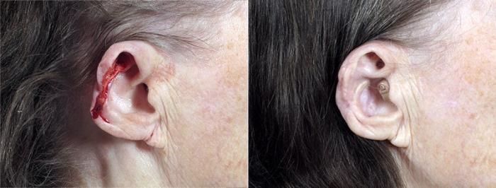 Skin Cancer Treatment Case 1080 Before & After View #1 | Paramus, New Jersey | Parker Center for Plastic Surgery