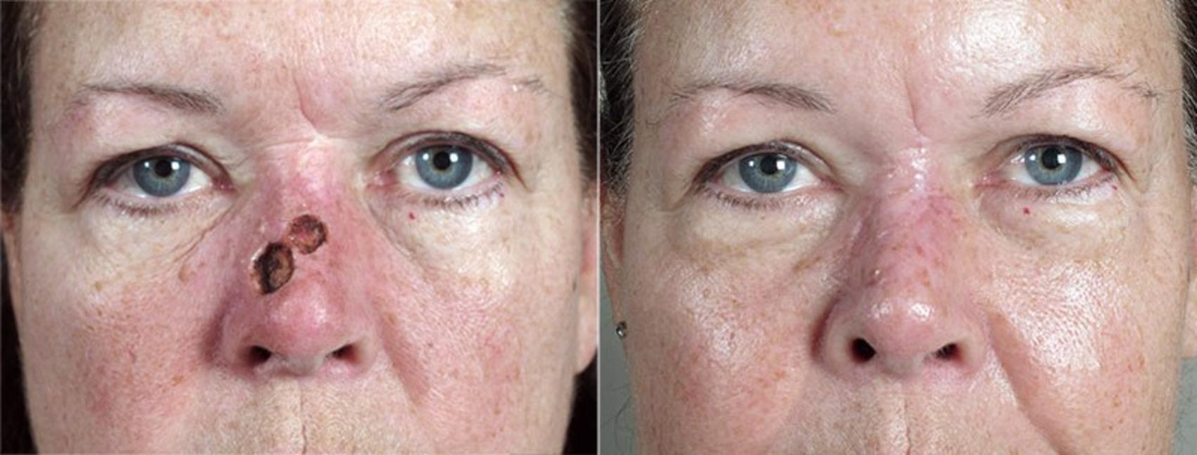 Skin Cancer Treatment Case 1081 Before & After View #1 | Paramus, New Jersey | Parker Center for Plastic Surgery