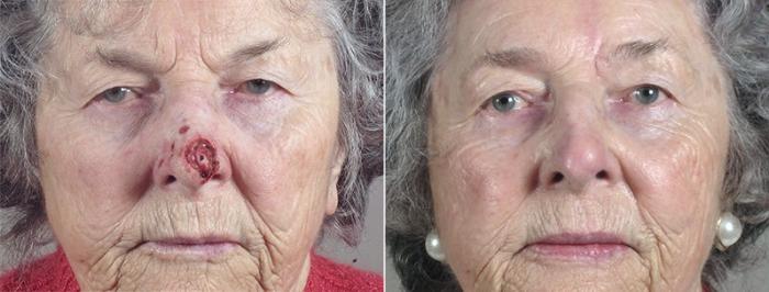 Skin Cancer Treatment Case 1082 Before & After View #1 | Paramus, New Jersey | Parker Center for Plastic Surgery