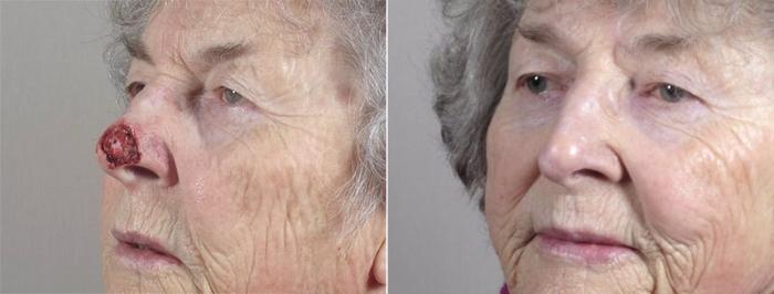 Skin Cancer Treatment Case 1082 Before & After View #2 | Paramus, New Jersey | Parker Center for Plastic Surgery
