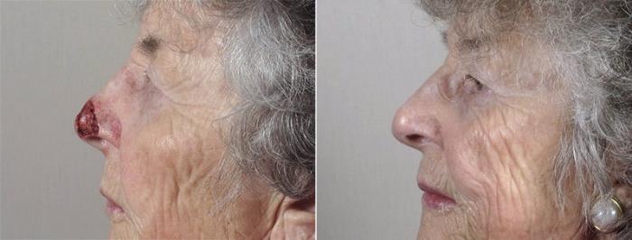 Skin Cancer Treatment Case 1082 Before & After View #3 | Paramus, New Jersey | Parker Center for Plastic Surgery