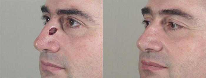 Skin Cancer Treatment Case 1083 Before & After View #1 | Paramus, New Jersey | Parker Center for Plastic Surgery
