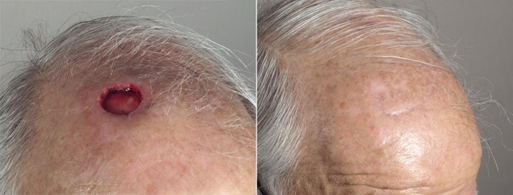 Skin Cancer Treatment Case 1084 Before & After View #1 | Paramus, New Jersey | Parker Center for Plastic Surgery