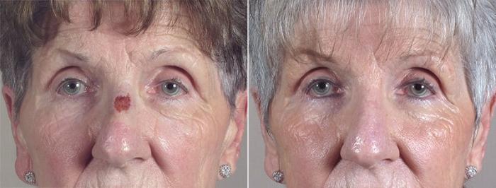 Skin Cancer Treatment Case 1085 Before & After View #1 | Paramus, New Jersey | Parker Center for Plastic Surgery