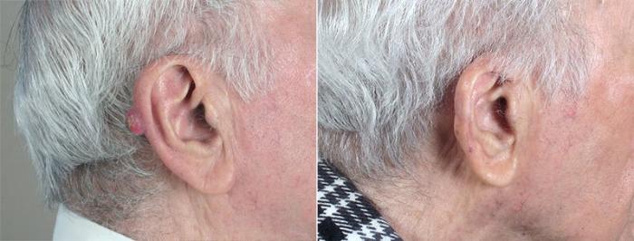 Skin Cancer Treatment Case 1086 Before & After View #1 | Paramus, New Jersey | Parker Center for Plastic Surgery
