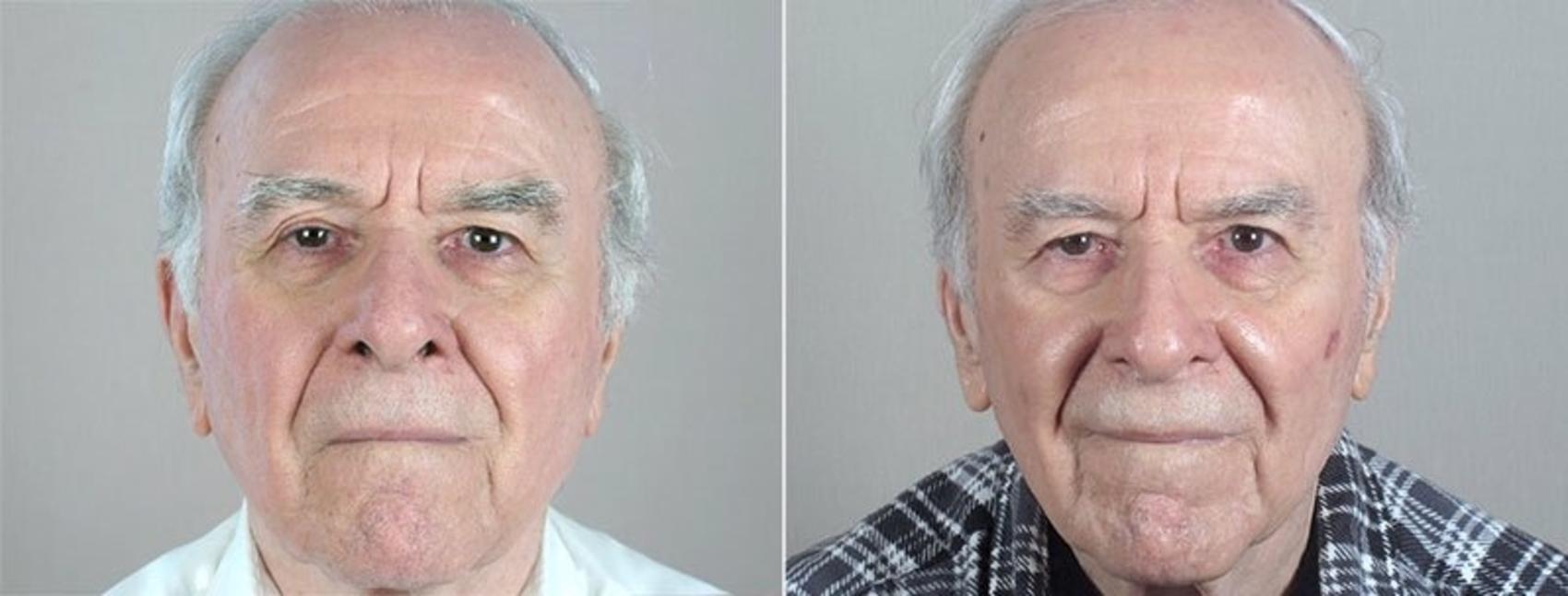 Skin Cancer Treatment Case 1086 Before & After View #2 | Paramus, New Jersey | Parker Center for Plastic Surgery