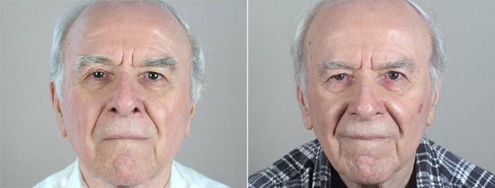 Skin Cancer Treatment Case 1086 Before & After View #2 | Paramus, New Jersey | Parker Center for Plastic Surgery