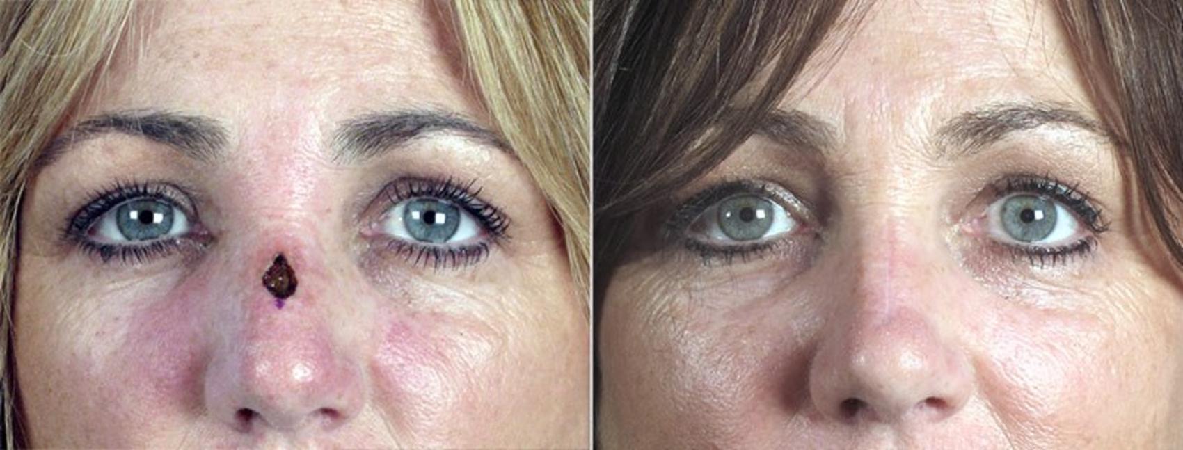 Skin Cancer Treatment Case 1087 Before & After View #1 | Paramus, New Jersey | Parker Center for Plastic Surgery