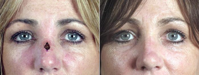 Skin Cancer Treatment Case 1087 Before & After View #1 | Paramus, New Jersey | Parker Center for Plastic Surgery