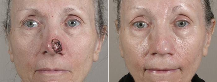 Skin Cancer Treatment Case 1088 Before & After View #1 | Paramus, New Jersey | Parker Center for Plastic Surgery
