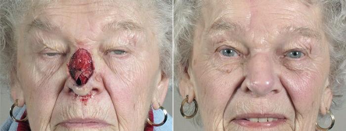 Skin Cancer Treatment Case 1089 Before & After View #1 | Paramus, New Jersey | Parker Center for Plastic Surgery