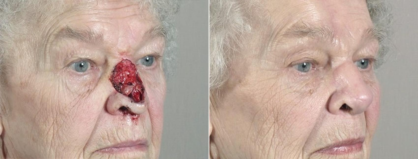 Skin Cancer Treatment Case 1089 Before & After View #2 | Paramus, New Jersey | Parker Center for Plastic Surgery