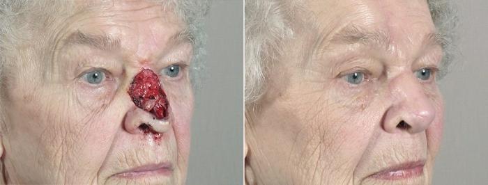 Skin Cancer Treatment Case 1089 Before & After View #2 | Paramus, New Jersey | Parker Center for Plastic Surgery