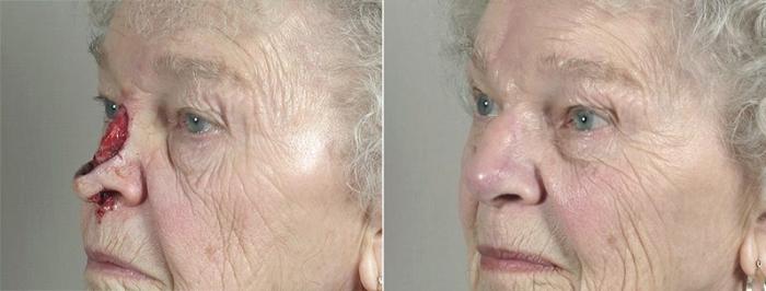 Skin Cancer Treatment Case 1089 Before & After View #3 | Paramus, New Jersey | Parker Center for Plastic Surgery