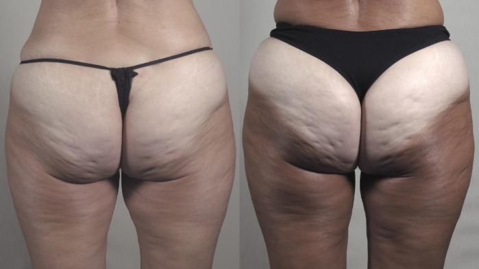 Thigh Lift Case 1274 Before & After Back | Paramus, New Jersey | Parker Center for Plastic Surgery