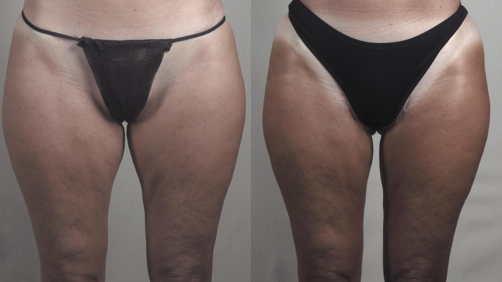 Thigh Lift Case 1274 Before & After Front | Paramus, New Jersey | Parker Center for Plastic Surgery