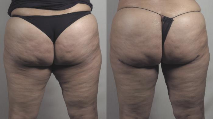 Liposuction Case 1275 Before & After Back | Paramus, New Jersey | Parker Center for Plastic Surgery