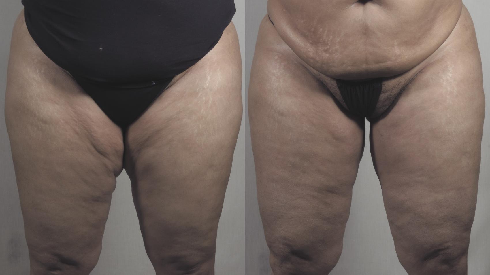 Liposuction Case 1275 Before & After Front | Paramus, New Jersey | Parker Center for Plastic Surgery