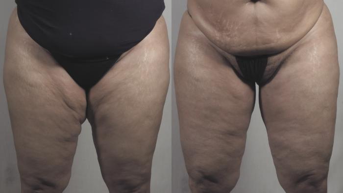 Thigh Lift Case 1275 Before & After Front | Paramus, New Jersey | Parker Center for Plastic Surgery