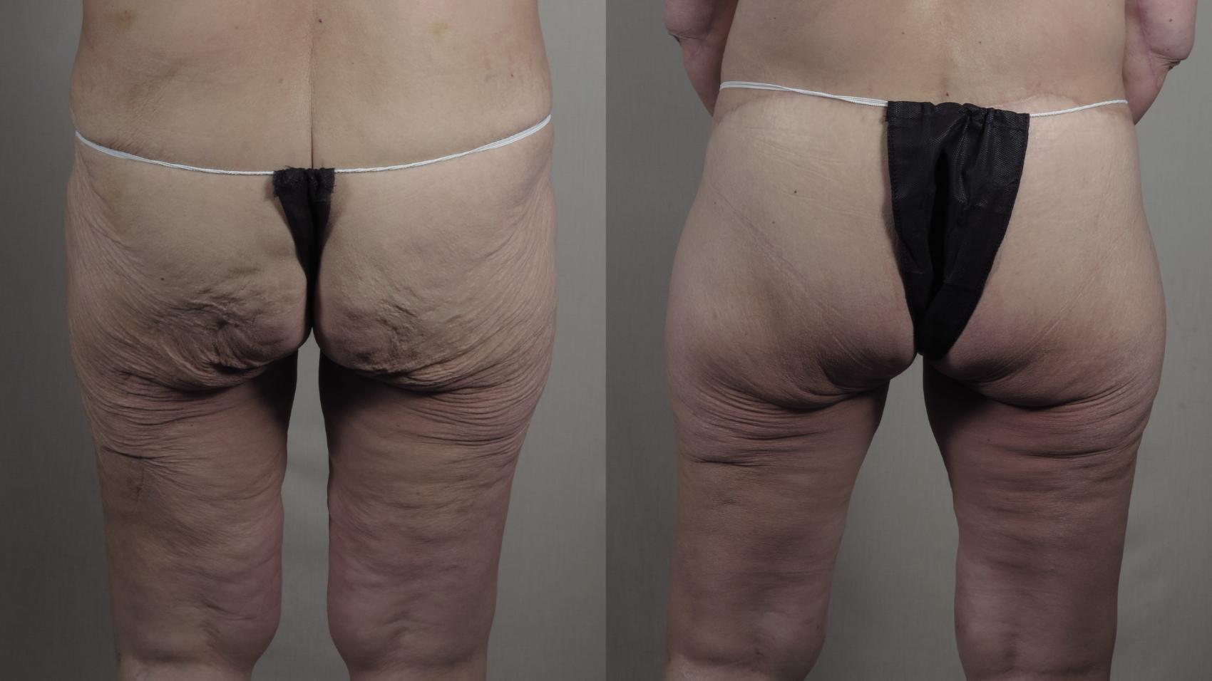 Thigh Lift Case 1304 Before & After Back | Paramus, New Jersey | Parker Center for Plastic Surgery